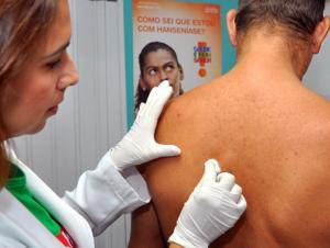 notícia: Sespa intensifica ações para manter a hanseníase em baixa no Pará