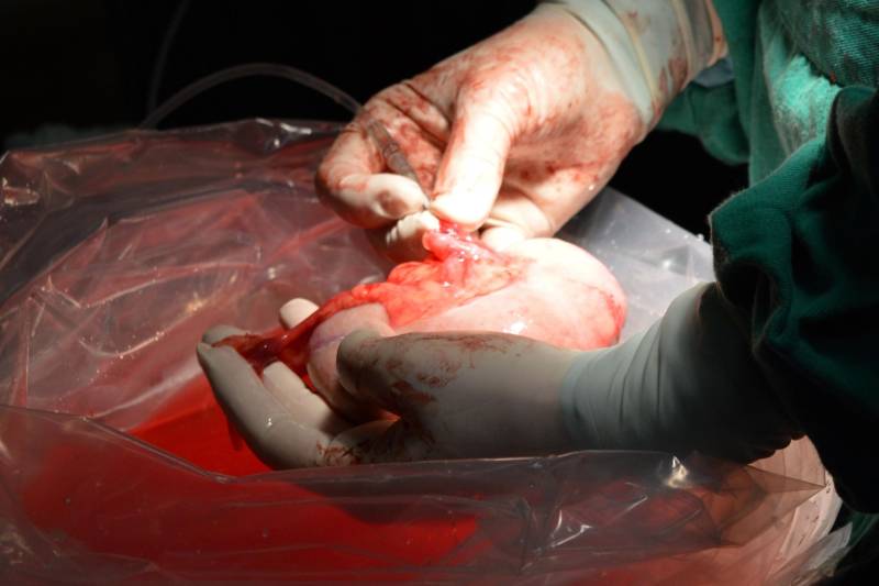O estudante Jheiel Brito, de 19 anos, é o terceiro transplantado do Hospital Regional do Baixo Amazonas (HRBA), em Santarém (PA). O jovem recebeu o rim da sua mãe, Walderlene Brito, de 50 anos. Com mais esse procedimento, realizado na terça-feira, 13, a unidade já soma três transplantes em um período de 40 dias.
FOTO: ASCOM HRBA / ARQUIVO
DATA: 15.12.2016
SANTARÉM - PARÁ <div class='credito_fotos'>Foto: Ascom HRBA | <a href='/midias/2018/originais/0b66252a-18f8-4420-9df6-97fe6155782b.jpg' download><i class='fa-solid fa-download'></i> Download</a></div>
