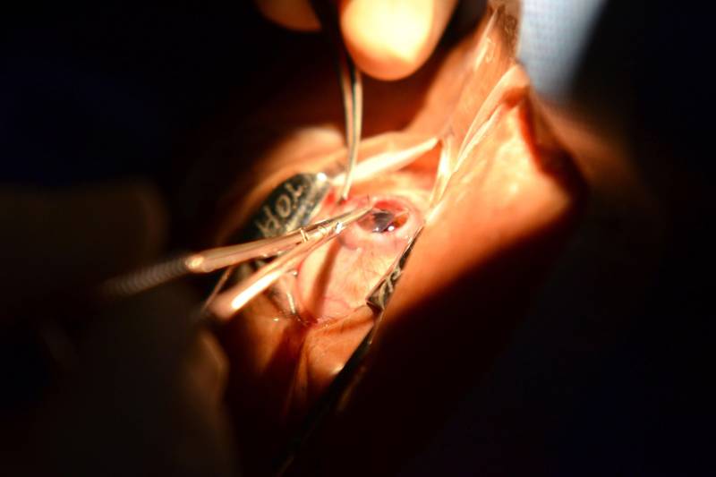 A preocupação com a estética muitas vezes supera a atenção dedicada à saúde e pode trazer danos irreversíveis como a perda da visão. Um trauma ocular ocasionado pelo mau uso de uma lente de contato, comprada sem orientação médica, levou o eletricista Lívio Reis, 28, a entrar na fila de espera por um transplante de córnea (foto). Ele conta que usar lentes de contato para fins estéticos era uma verdadeira febre entre os mais jovens no ano de 2008. Não pensou duas vezes, adquiriu as lentes num camelô.
FOTO: ARQUIVO / ASCOM HOL
DATA: 16.03.2017
BELÉM - PARÁ <div class='credito_fotos'>Foto: ASCOM HOIOL | <a href='/midias/2018/originais/26999ded-b0b5-4efc-b2db-c1b9be0d6fd1.jpg' download><i class='fa-solid fa-download'></i> Download</a></div>