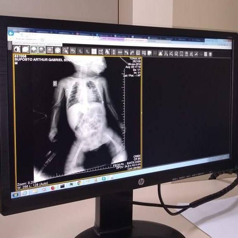 A Santa Casa do Pará Hospital de Referência Materno- Infantil do Estado, é referência nas áreas de  Tocoginecologia, Pediatria, Neonatologia, Clínica Médica, Clínica Cirúrgica, Nefropediatria, Ambulatórios (Mulher, Pediatria, Cirurgia e especialidade) e desenvolve relevantes ações de Ensino, Pesquisa e Extensão, com Pós-graduação Lato Sensu (12 programas de residência médica e 1 de Residência multiprofissional) e Pós-graduação Scricto Sensu (mestrado). Nos últimos 7 anos e 10 meses, a Santa Casa atendeu 343.781 pacientes da Capital e do Interior do Estado na Unidade de Urgência e Emergência Obstétrica. O Hospital também realizou 162.191 internações, nesse período. O número de partos realizados pela Maternidade da Santa Casa foi de 69.512 e o hospital realizou ainda 30.289. Mas essas, não são as únicas boas notícias que temos para a população paraense. Mais uma conquista está sendo comemorada por gestores e servidores da instituição: a realização de teste das imagens radiológicas digitais pelo Radiology Information System (RIS) - Sistema de Informação de Radiologia e PACS disponibilizadas para todos os pacientes da nossa Santa Casa. Na foto, realização de teste das imagens radiológicas digitais pelo Radiology Information System (RIS) - Sistema de Informação de Radiologia e PACS disponibilizadas para todos os pacientes da nossa Santa Casa.

FOTO: ASCOM / SANTA CASA
DATA:27.11.2018
BELÉM - PARÁ <div class='credito_fotos'>Foto: Ascom Santa Casa   |   <a href='/midias/2018/originais/bba48bab-e348-46cc-ad64-e254bf07c25e.jpg' download><i class='fa-solid fa-download'></i> Download</a></div>