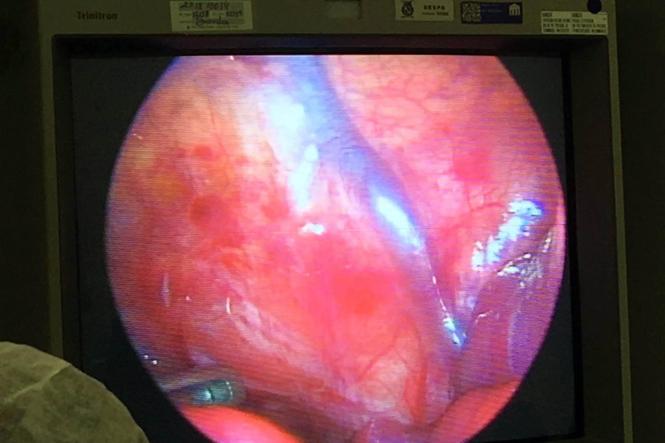 Já está em casa e se alimentando corretamente a bebê que passou pela cirurgia de videotoracoscopia (Cirurgia torácica videoassistida). Essa foi a primeira vez que a equipe médica de cirurgia pediátrica da Santa Casa realizou o procedimento. A intervenção cirúrgica foi necessária para realizar uma correção no esôfago do bebê, a criança tinha atresia de esôfago, uma má formação que o impede de se alimentar corretamente.

FOTO: ASCOM SANTA CASA
DATA: 05.02.2019
BELÉM - PARÁ <div class='credito_fotos'>Foto: Ascom Santa Casa   |   <a href='/midias/2019/originais/d0b22e98-8e22-4bd1-bc8f-5a1615d0a3fe.jpg' download><i class='fa-solid fa-download'></i> Download</a></div>