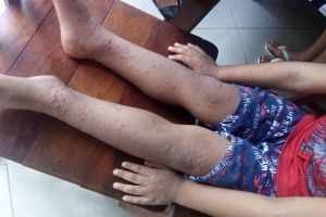 notícia: Sespa alerta sobre casos de síndrome mão-pé-boca no Pará
