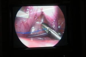 galeria: Santa Casa realiza com sucesso primeira videotoracoscopia do Norte do Brasil