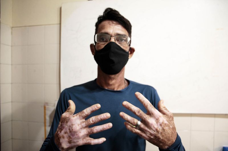 Atendimentos Dermatológicos UEPA
Na foto; José Claudio, paciente dermatológico. <div class='credito_fotos'>Foto: Bruno Cecim / Ag.Pará | <a href='/midias/2020/originais/6533_45f23217-8ddd-6568-69db-cea50e698d42.jpg' download><i class='fa-solid fa-download'></i> Download</a></div>