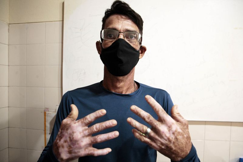 Atendimentos Dermatológicos UEPA
Na foto; José Claudio, paciente dermatológico. <div class='credito_fotos'>Foto: Bruno Cecim / Ag.Pará | <a href='/midias/2020/originais/6533_f3046162-1fd4-eb04-23cb-50fe1fafb724.jpg' download><i class='fa-solid fa-download'></i> Download</a></div>