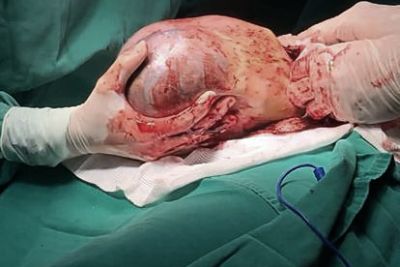 notícia: Em fenômeno raro, Santa Casa registra nascimento de gêmeo dentro da bolsa amniótica da mãe