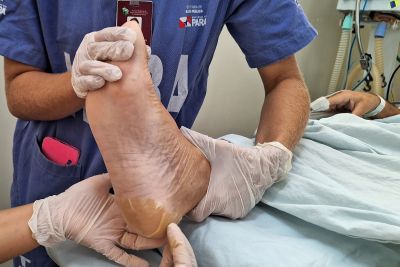 notícia: Time Cuidador de Pele do HRBA atua na prevenção de lesões por pressão